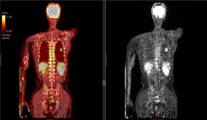 Study of 50,000 people finds brown fat may protect against numerous chronic diseases